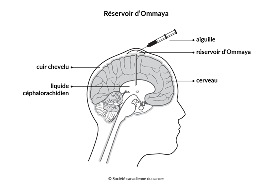 Schéma du réservoir d’Ommaya