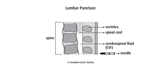 Diagram of lumbar puncture