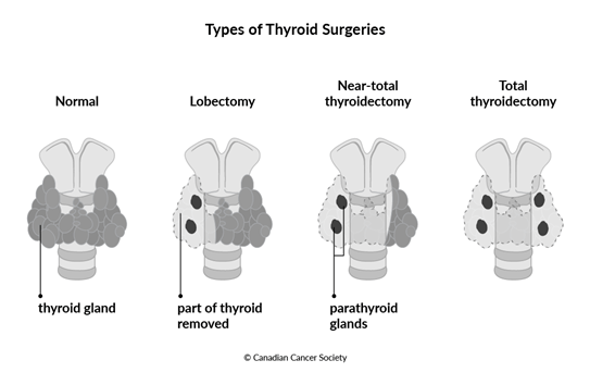 Diagram of types of thyroid surgeries