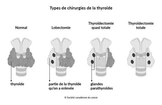 Schéma des types de chirurgies de la thyroïde