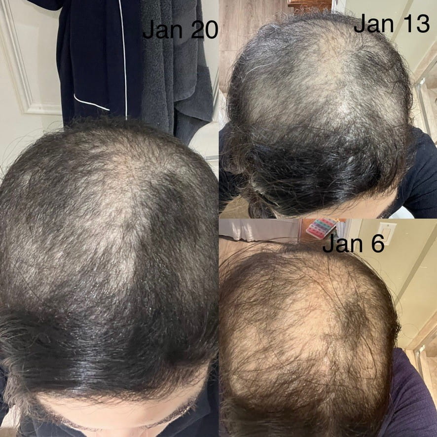 A collage of Robby’s hair growth over 3 weeks in January 2024.