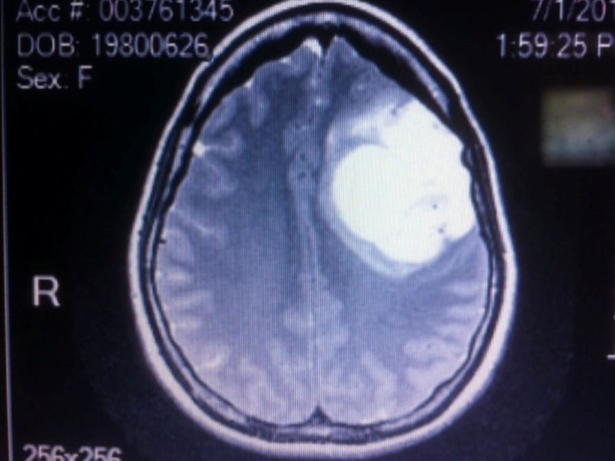 Ce cliché du cerveau de Catherine montre une importante masse du côté droit.