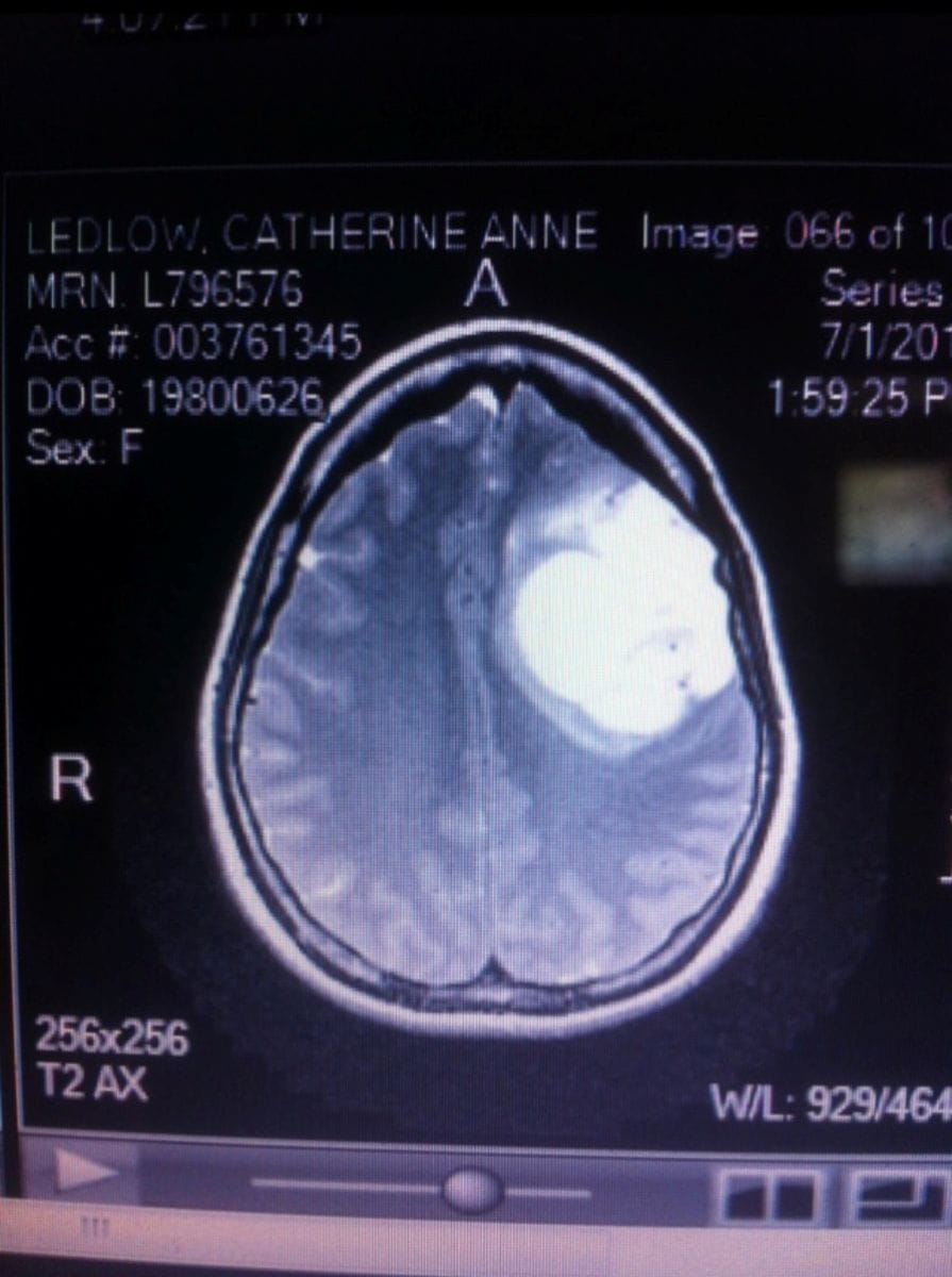 A scan shows a large mass on the right side of Catherine’s brain. 