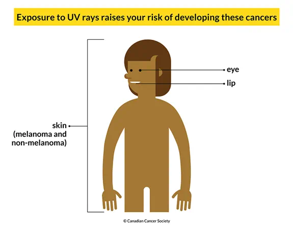 Body showing that exposure to UV rays increases the risk of developing skin, eye and lip cancers