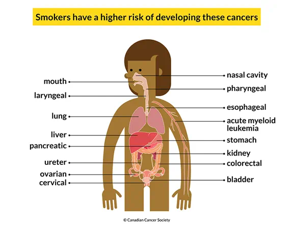 A body showing 16 cancers people have a higher risk of developing if they smoke: mouth, lung, liver, etc.