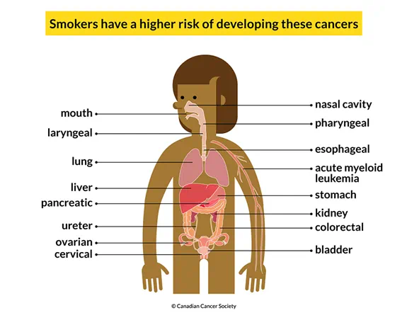 A body showing 16 cancers smokers have a higher risk of developing: mouth, lung, liver, etc.
