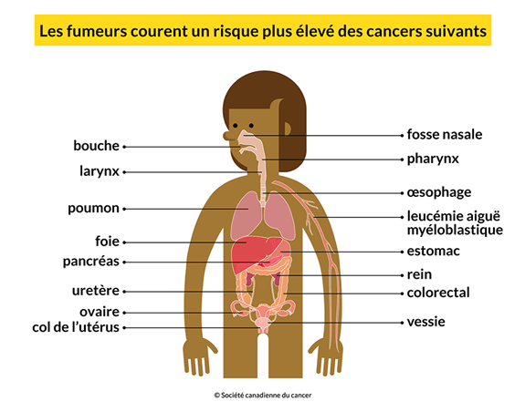 Un corps montrant les 16 cancers que les fumeurs risquent davantage de développer: bouche, poumon, foie, etc.