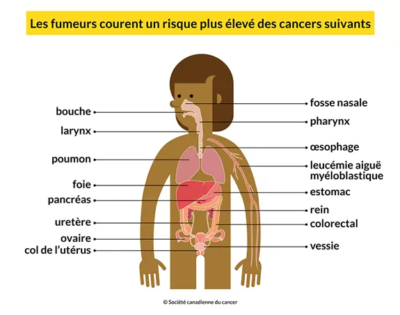 Un corps montrant les 16 cancers que les fumeurs risquent davantage de développer: bouche, poumon, foie, etc.