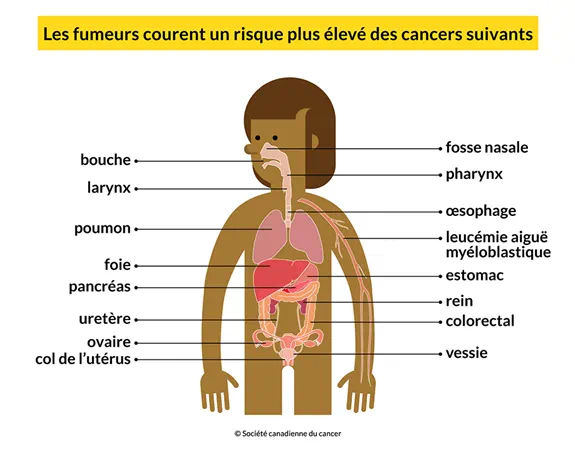 Un corps montrant les 16 cancers dont les personnes qui fument risquent d’être atteintes: bouche, poumon, foie, etc.