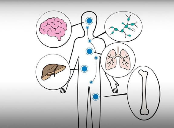 Illustration d'un corps où sont dessinés des ganglions lymphatiques, un os, un cerveau, un foie et des poumons