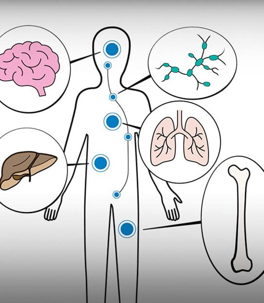 Illustration d'un corps où sont dessinés des ganglions lymphatiques, un os, un cerveau, un foie et des poumons