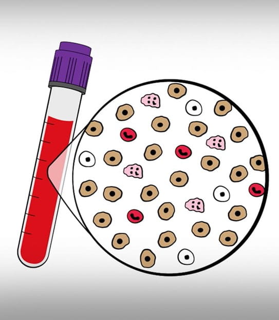 Échantillon de sang contenant un mélange de cellules saines et anormales